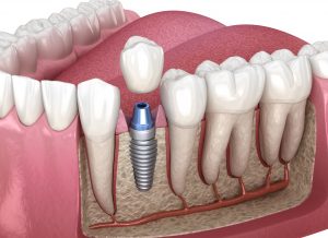 The More Intricate Way Dental Implants Replace Teeth