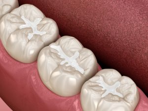 auburn hills dentist fillings