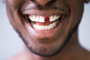 Close Up Photo Of Young Man With Missing Tooth