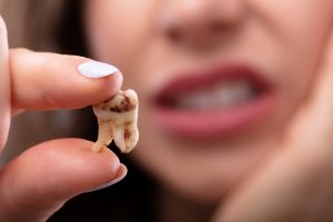 Close-up Of A Woman's Hand Holding Decay Tooth