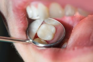 close-up of a human rotten carious tooth at the treatment stage in a dental clinic. The use of rubber dam system with latex scarves and metal clips, production of photopolymeric composite fillings