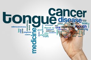 Tongue cancer word cloud concept on grey background