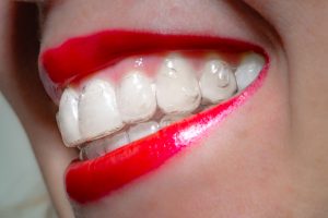 A woman's smiling mouth with red lips wearing invisible orthodontic aligners, side view