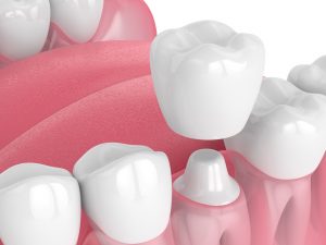 3d render of jaw with teeth and dental crown restoration over white background