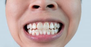 Close-up of a smiling woman's teeth revealing white spots and plaque on the tooth surface. Oral care and Dental concept.