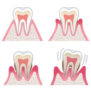 歯の断面図　歯周病