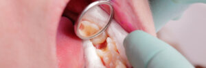 Close up of hole in tooth after drilling with dental rolls and mirror