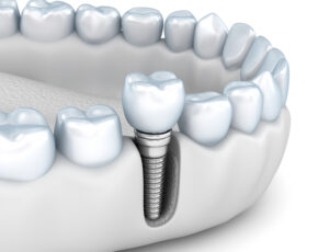 Tooth implant instalation process , Medically accurate 3D illustration white style