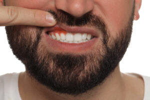 Young man showing inflamed gums, closeup view