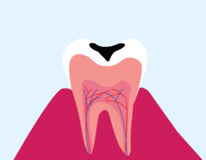vector background of tooth decay
