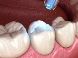 Tooth restoration with filling and polymerization lamp. Medically accurate tooth 3D illustration.