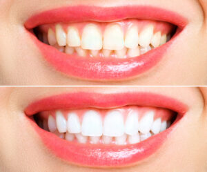 auburn hills teeth whitening