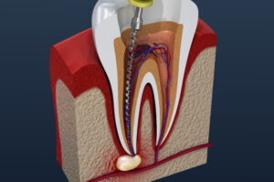 Root canal treatment process. 3D illustration