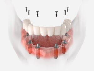 Restoration of mandible with 6 implants. 3D illustration of dent
