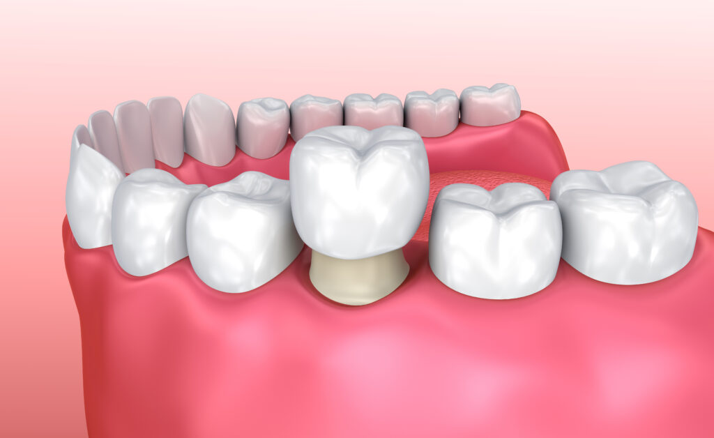 Advance Dental Concepts Offers CEREC same day crowns 