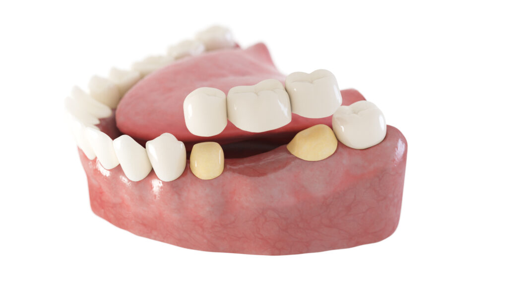 Auburn Hills, MI, dentist offers dental bridges and dentures to replace lost teeth 